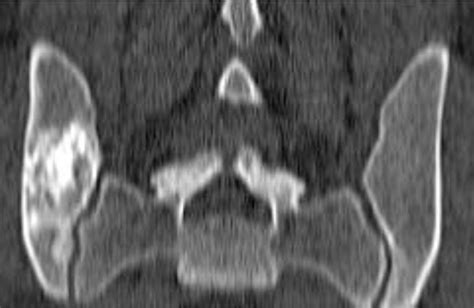 Desmoplastic Fibroma A Case Report With Three Years Of Clinical And