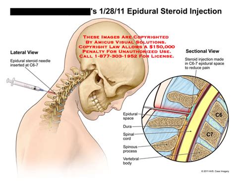 Epidural Steroid Injection