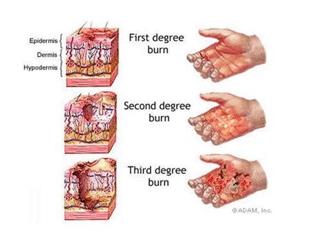 Difference Between 1st 2nd And 3rd Degree Burns