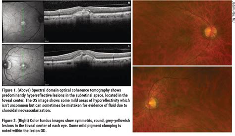 Pseudo Vitelliform Dystrophy