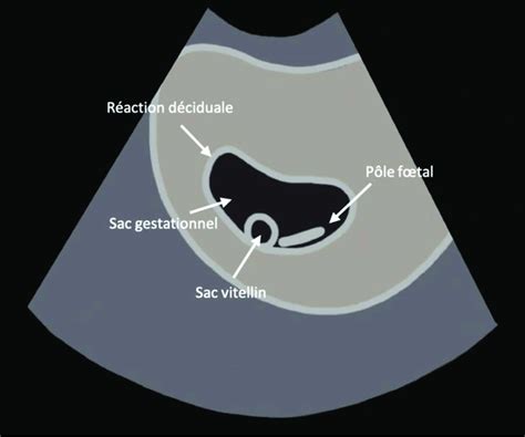 Sch Ma Chographique Du P Le Foetal Dans Le Sac Gestationnel Le P Le