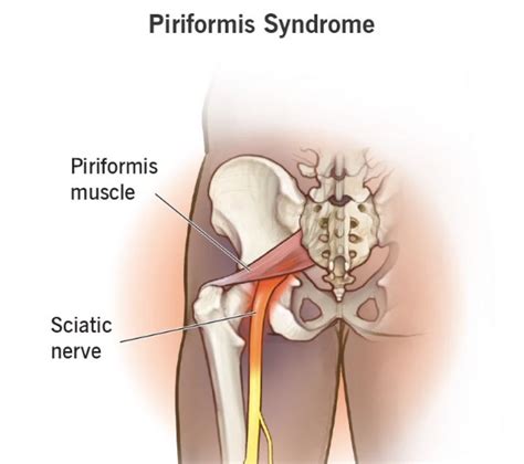 Piriformis Syndrome Symptoms Causes And Treatments