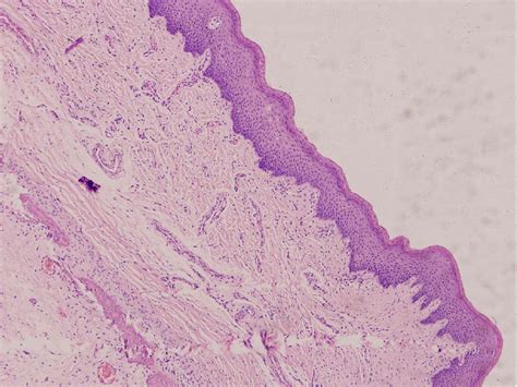 Nasopharyngeal Teratoma Associated With Cleft Palate In Newborn Report