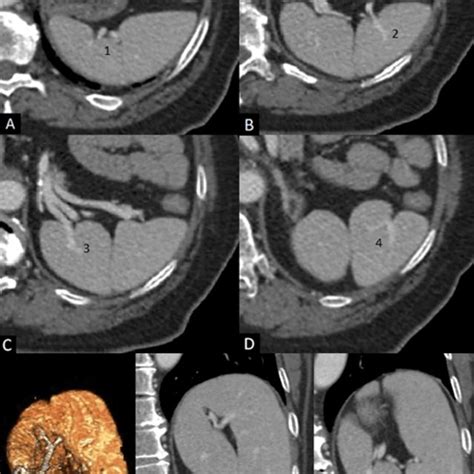 Splenosis Normal Spleen Is Absent There Are Multiple Round Enhancing