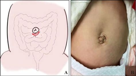 Traditional Infraumbilical Incision In A Neonate The Situation Of Download Scientific Diagram