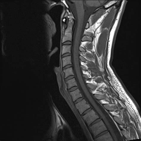 Normal Neck Mri Scan