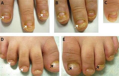 Onychomadesis, definition, causes, symptoms, diagnosis & treatment