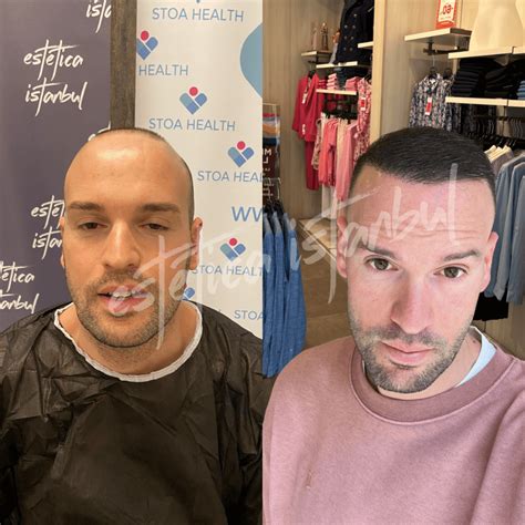 Hair Transplant Turkey Before After Estetica Istanbul