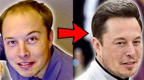 The Journey Of Elon Musk Hair Transplant Before After