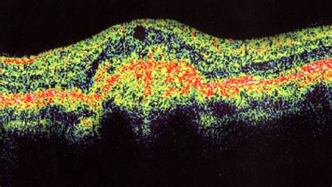 Optical Coherence Tomography OCT – Retina & Optic Nerve Scan - South ...