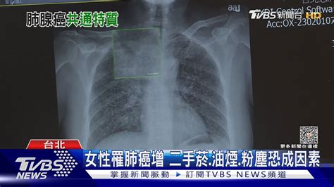 注意 不抽菸也會得肺腺癌 近年女性比例增｜十點不一樣20231030 Tvbsnews02 Youtube