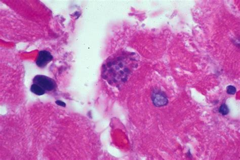 Mbbs Medicine Humanity First Myocarditis Etiology