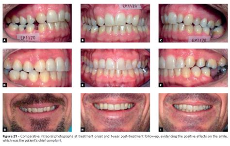 Scielo Brasil Orthodontic Treatment In Adults Restoring Smile