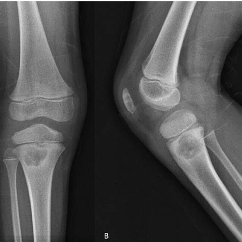 Right Knee Ap A And Lateral B Radiograph Demonstrating A Lytic Download Scientific Diagram