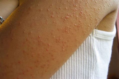 What You Need To Know About Keratosis Pilaris Stay At Home Mum