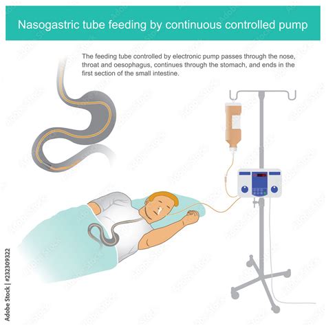 Nasogastric tube feeding by continuous controlled pump. The feeding tube controlled by ...