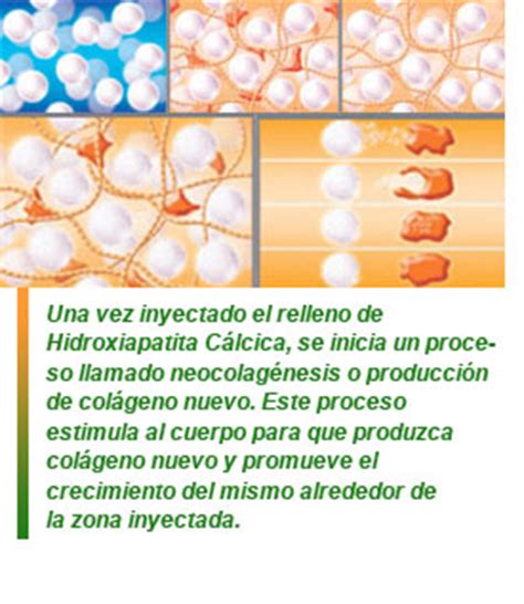 Relleno De Hidroxiapatita C Lcica Una Alternativa A Los Tratamientos