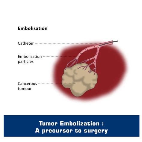 Tumor Embolization Expertise - Sushrut Brain and Spine