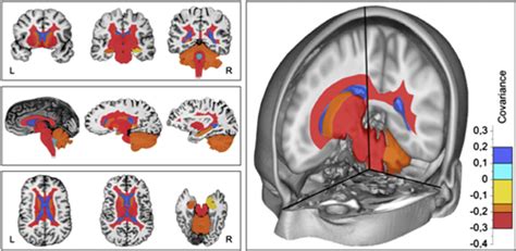 Ms Patients Positive For Oligoclonal Bands Have Greater Brain Atrophy