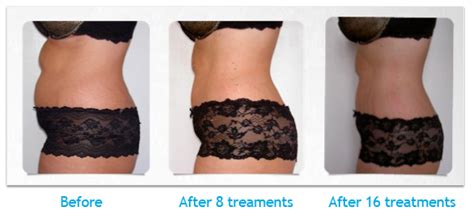 Non Invasive Liposuction Before And After Photos Infoupdate Org