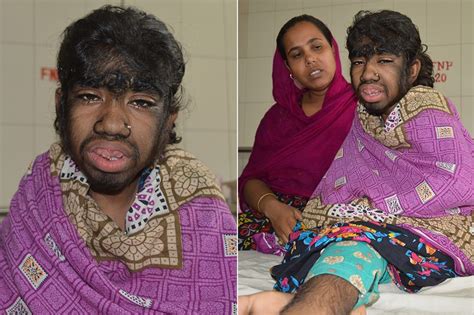 Werewolf Syndrome: This Girl's Rare Condition Will Creep You Out