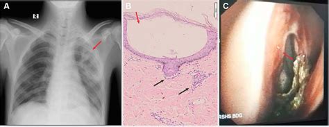 Figure 2 From Multiple Bullous And Ulcers As Cutaneous Manifestations