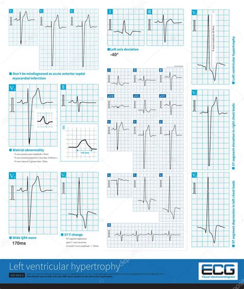 Left Ventricular Hypertrophy Can Cause A Series Of Ecg Changes Such As