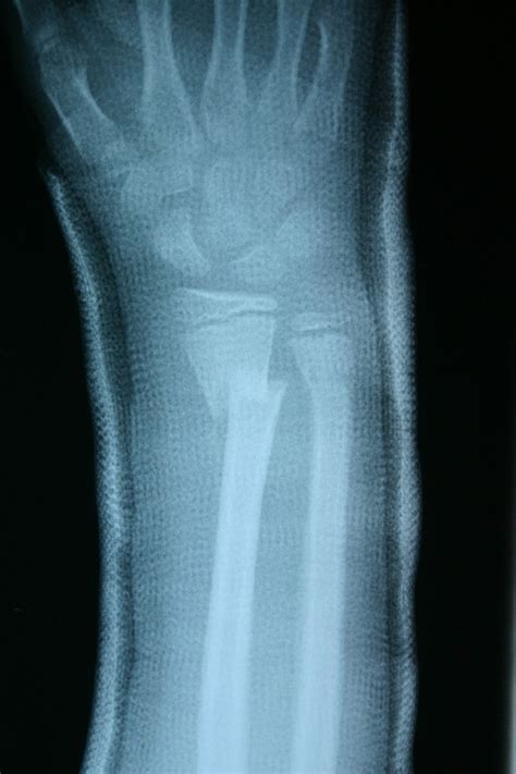 broken-arm-xray – Broken Arm Answers | Symptoms Treatment in Children ...