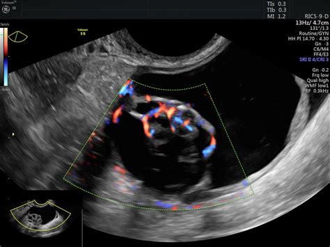 Using Color Doppler To Classify Ovarian Tumors Empowered Womens Health