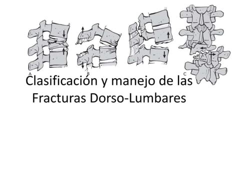 Clasificación Y Manejo De Las Fracturas Dorso Lumbares Final1pptx