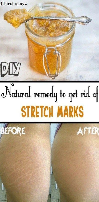 Natural Remedy To Get Rid Of Stretch Marks Remedies Natural Remedies