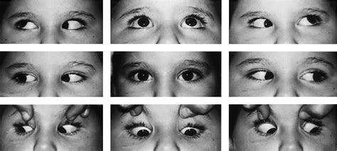 Figure 1 From Spontaneous Resolution Of Congenital Bilateral Brown’s Syndrome Semantic Scholar