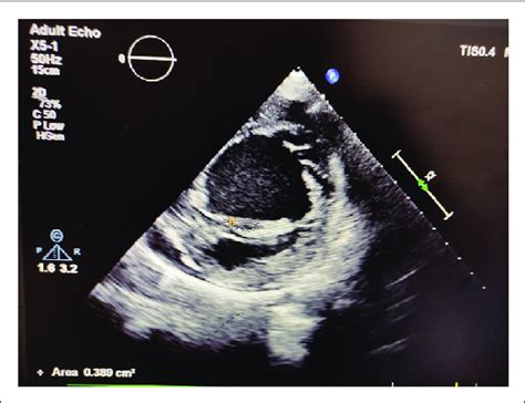 Parasternal Short Axis View Showing Mitral Valve Area To Be 0 4 Cm 2 By