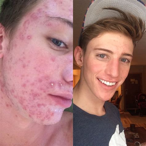 [acne] Another Accutane Saved My Skin Progress Pic Skincareaddiction