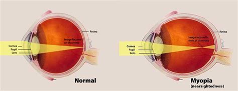 Atropine 0.01% Eye Drops - Controlling Myopia - Richmond Hill