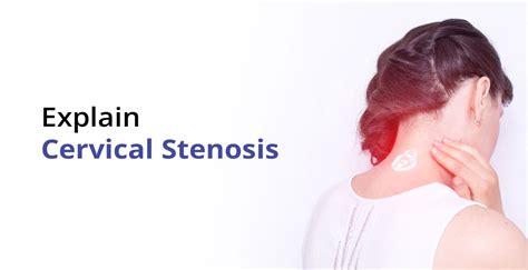 Cervical Stenosis Everything You Should Know Birla Fertility And Ivf