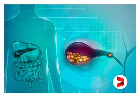 Como A Cirurgia De Retirada De Pedra Na Ves Cula Dr Douglas