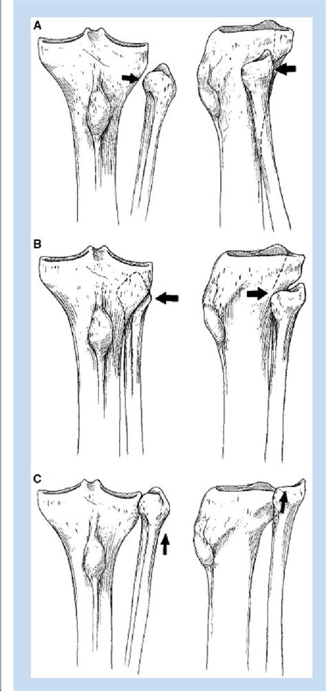 Figure 2 From Iliotibial Band Syndrome Semantic Scholar