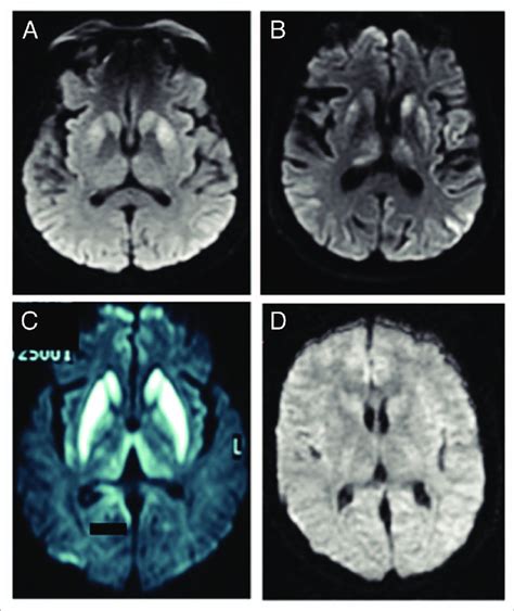 Bilateral Hyperintensities Of The Basal Ganglia In Case A B