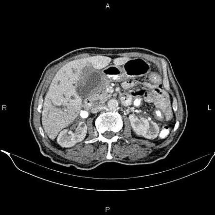 Locally Advanced Gallbladder Adenocarcinoma Radiology Case