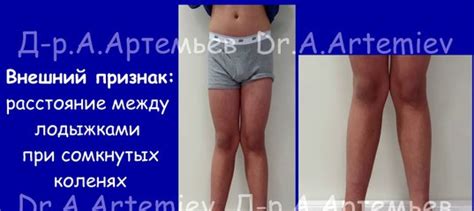кривые ноги | ВКонтакте