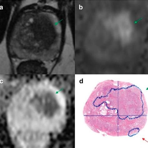 Clinically Significant Tumor Adjusted Overall Endorectal And
