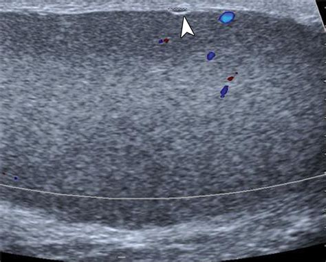 Us Of The Tunica Vaginalis Testis Anatomic Relationships And Pathologic Conditions Radiographics