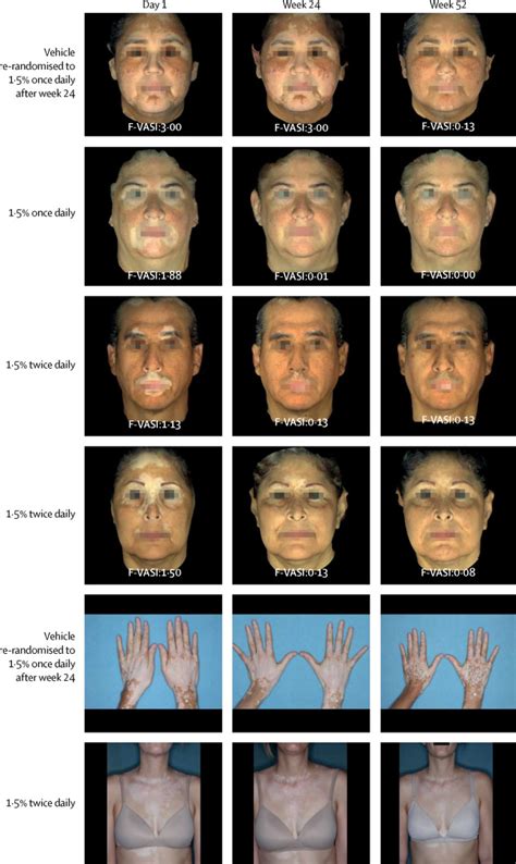 Ruxolitinib Cream For Treatment Of Vitiligo A Randomised Controlled