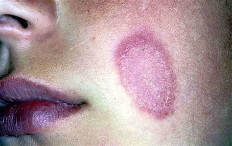 What Does Ringworm On Lips Look Like Lipstutorial Org