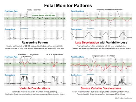 Understanding Fetal Monitor Patterns