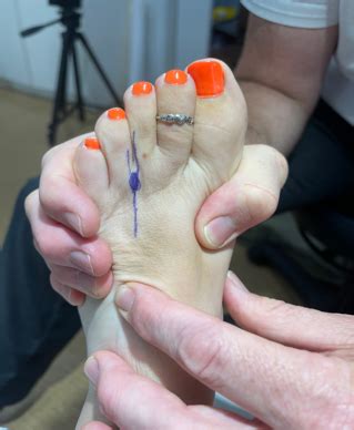 Mortons Neuroma Waikato Podiatry