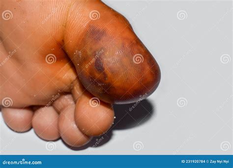 Abscess And Cellulitis Or Staphylococcal Streptococcal Skin Infection At The Big Toe Of Asian