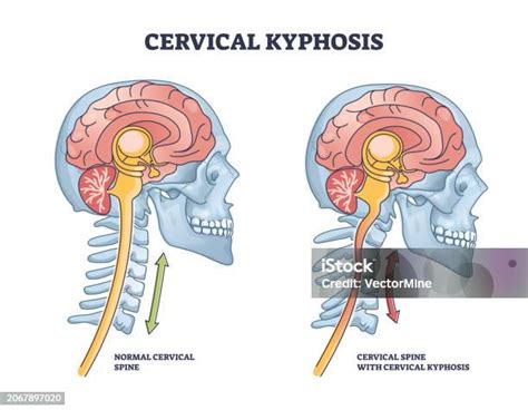 Ilustración De Condición De Cifosis Cervical Con Diagrama De Contorno