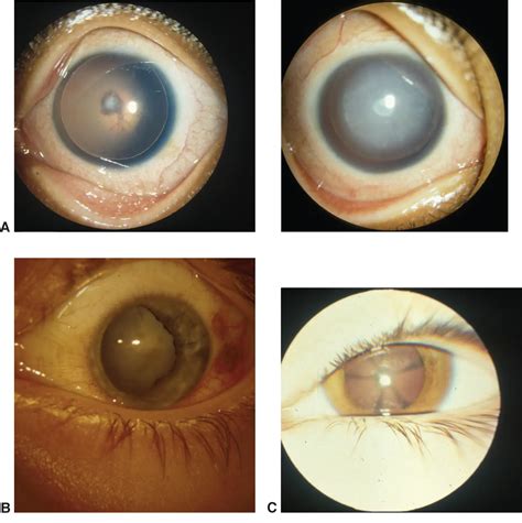 Childhood Cataracts American Academy Of Ophthalmology